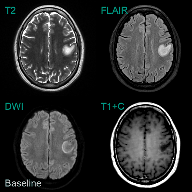 Balo S Concentric Sclerosis Neuroradiology