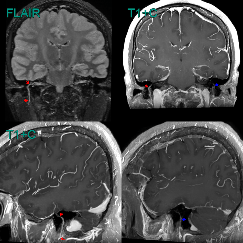 Bell's Palsy - NEURORADIOLOGY