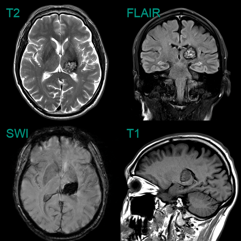 Cavernoma - NEURORADIOLOGY