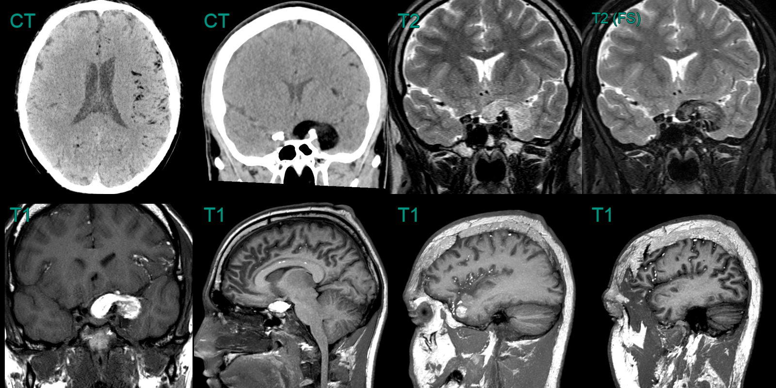 Dermoid cyst - NEURORADIOLOGY