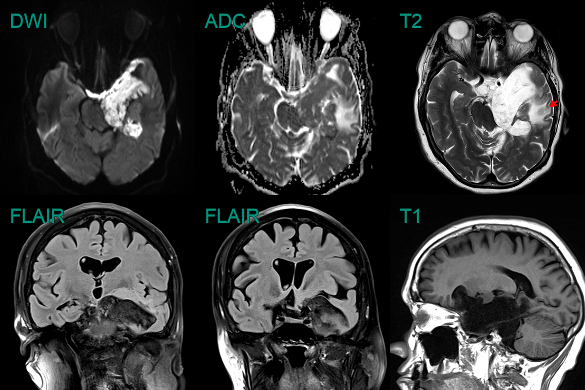 Epidermoid Cyst Neuroradiology 5777