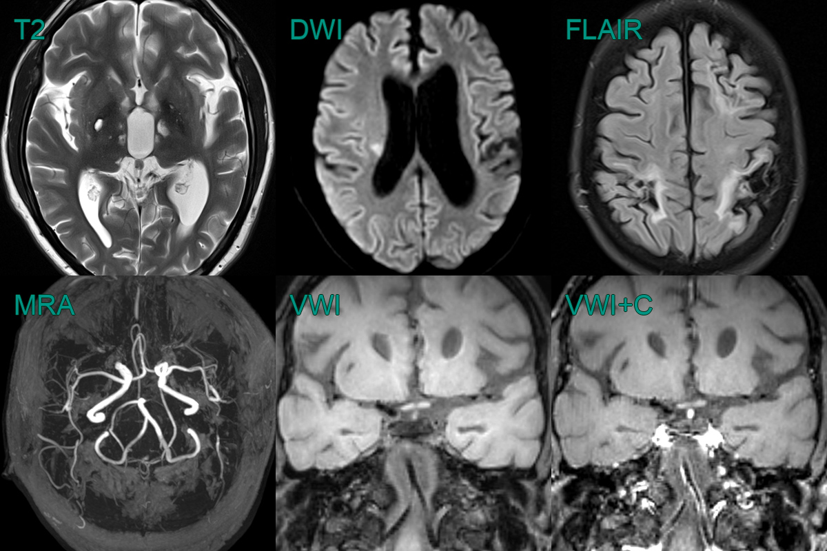 Fabry disease - NEURORADIOLOGY