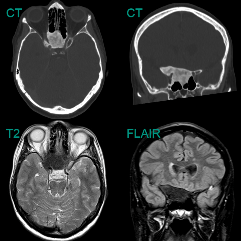 Fibrous dysplasia - NEURORADIOLOGY