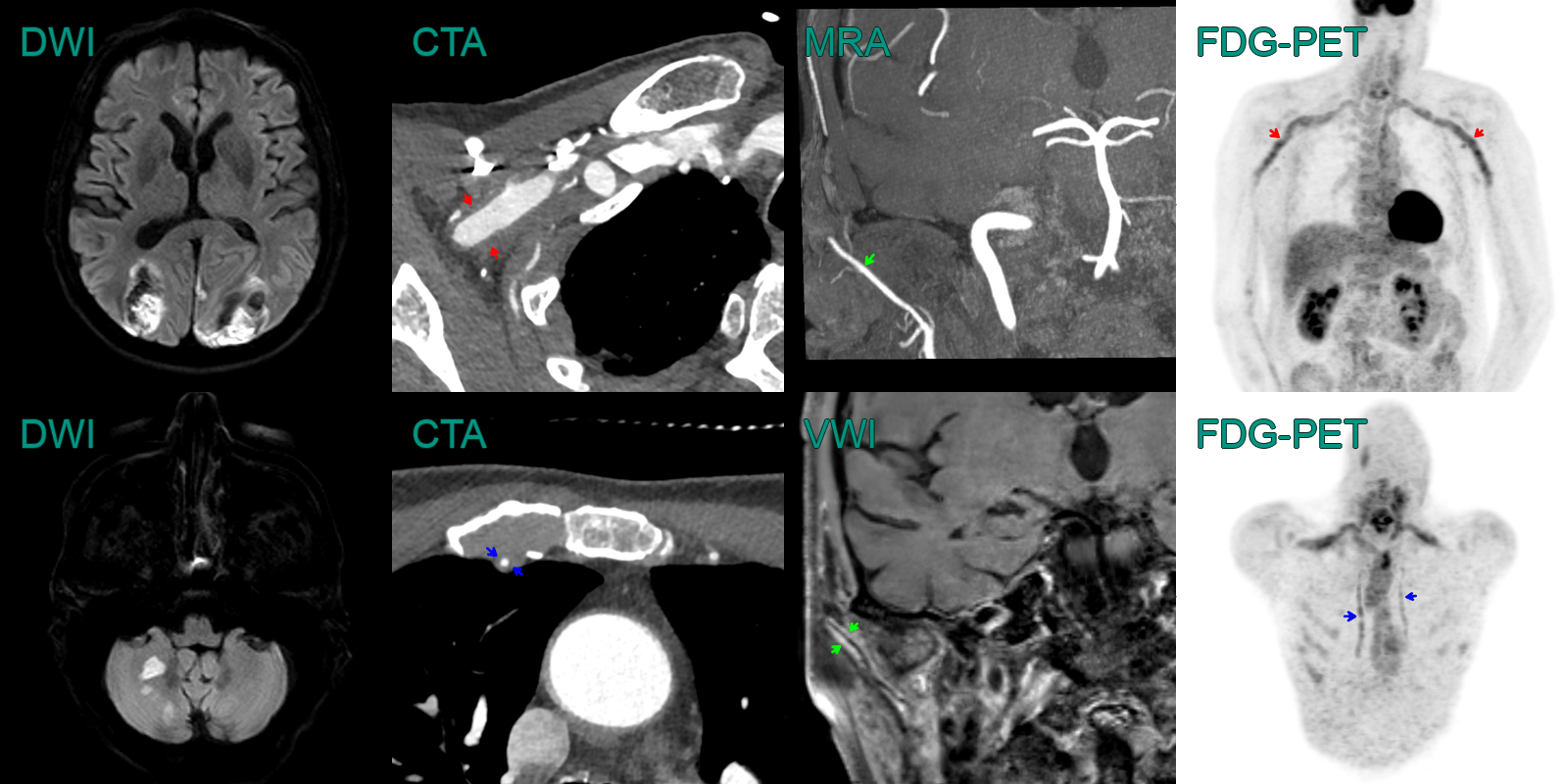 Giant cell arteritis - NEURORADIOLOGY