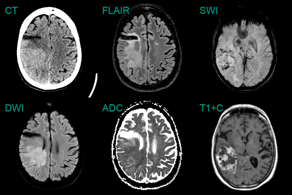 Glioblastoma - NEURORADIOLOGY