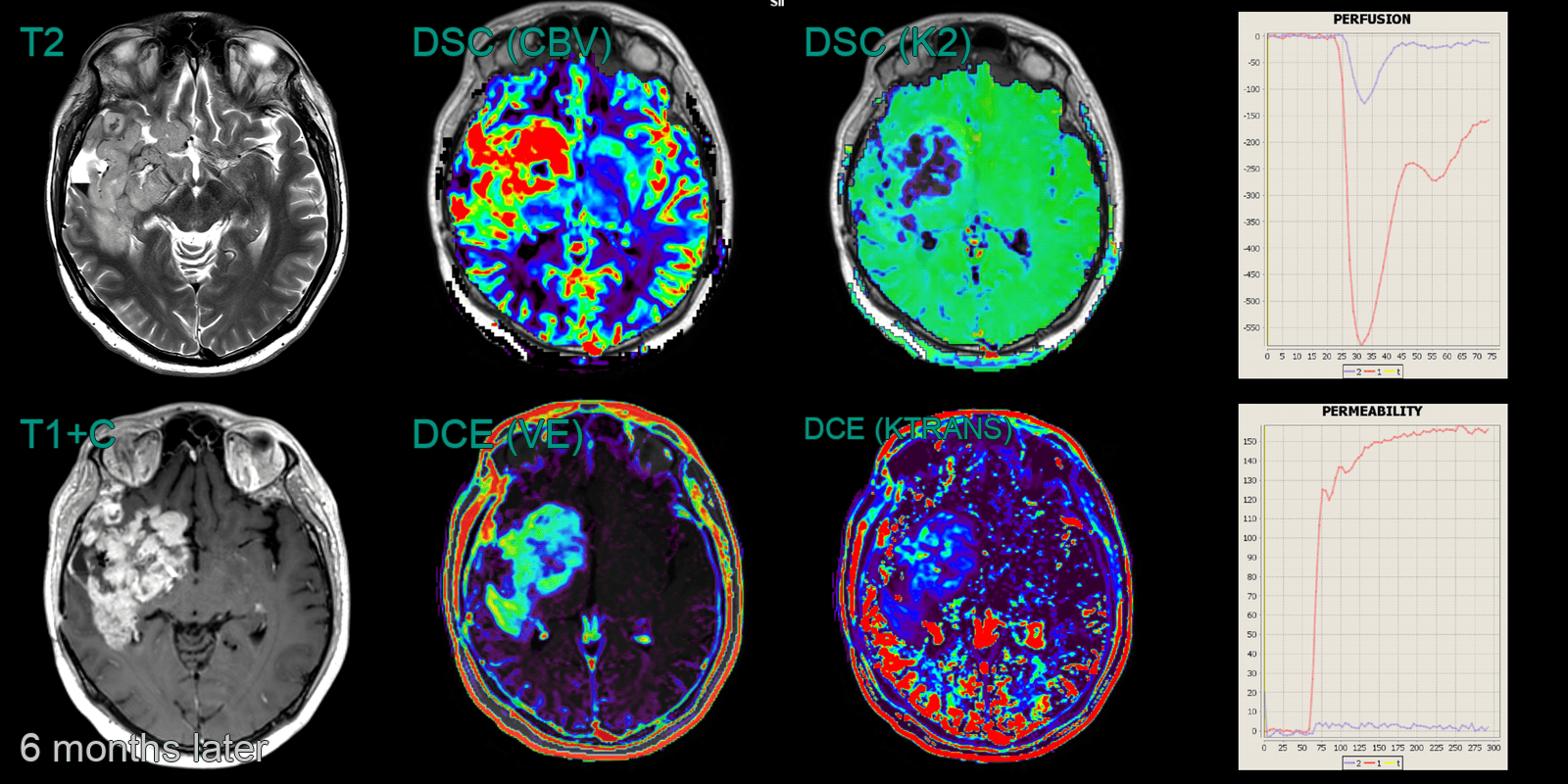 Glioblastoma - NEURORADIOLOGY