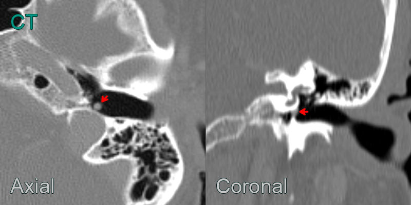 Glomus tympanicum - NEURORADIOLOGY