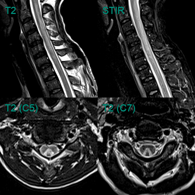 HIV-associated myelopathy - NEURORADIOLOGY