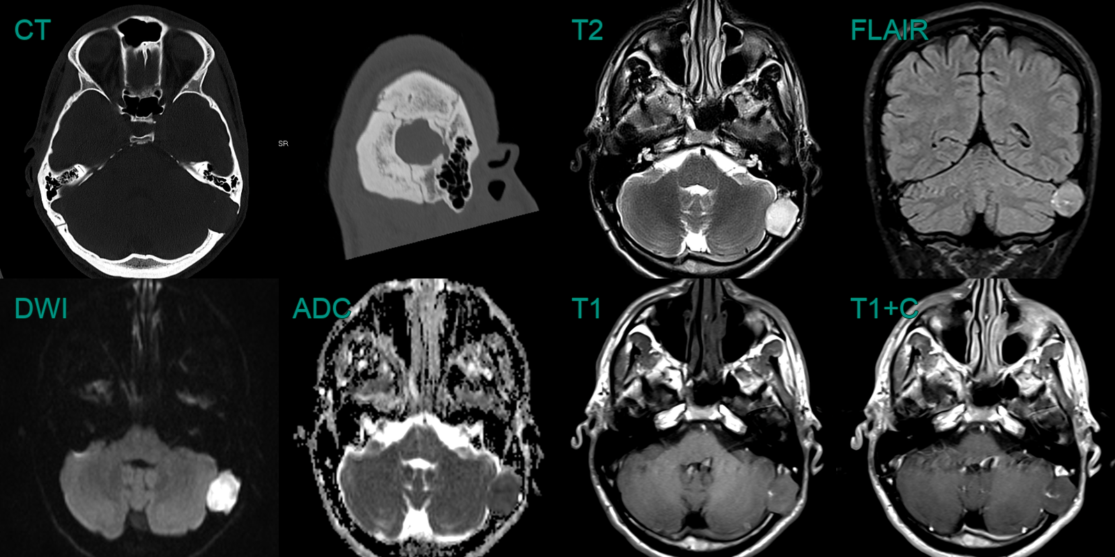 Intradiploic Epidermoid Neuroradiology 9168