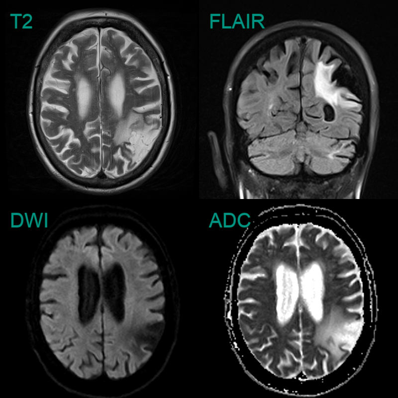 Ischaemic stroke - NEURORADIOLOGY