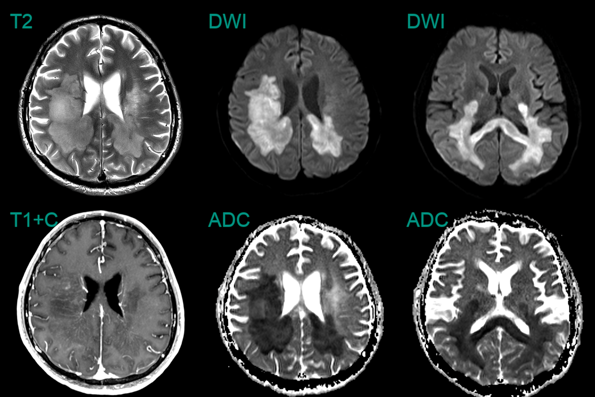 Multiple Sclerosis (MS) - NEURORADIOLOGY