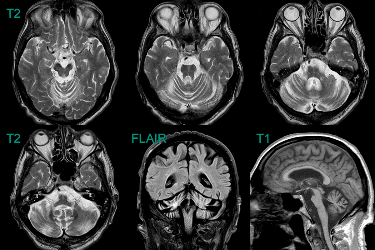 Multisystem Atrophy - Cerebellar Type (MSA-C) - NEURORADIOLOGY