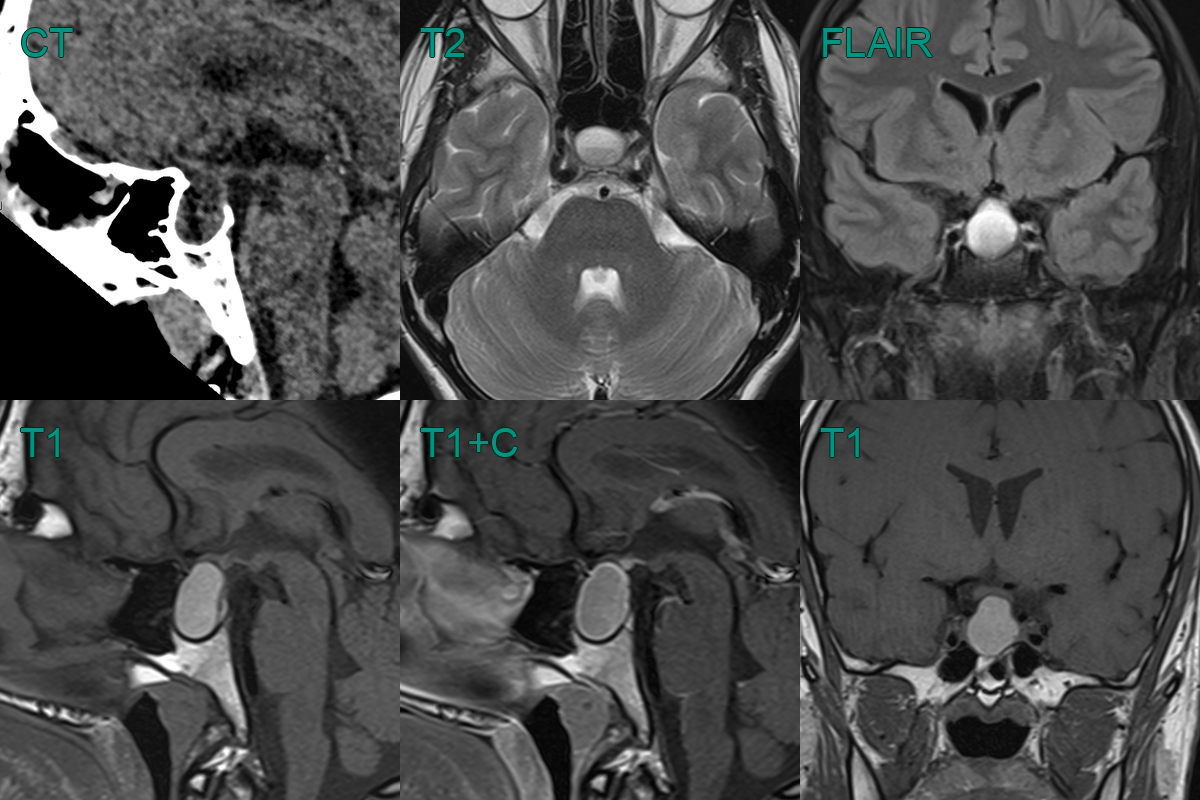 Rathke's cleft cyst - NEURORADIOLOGY