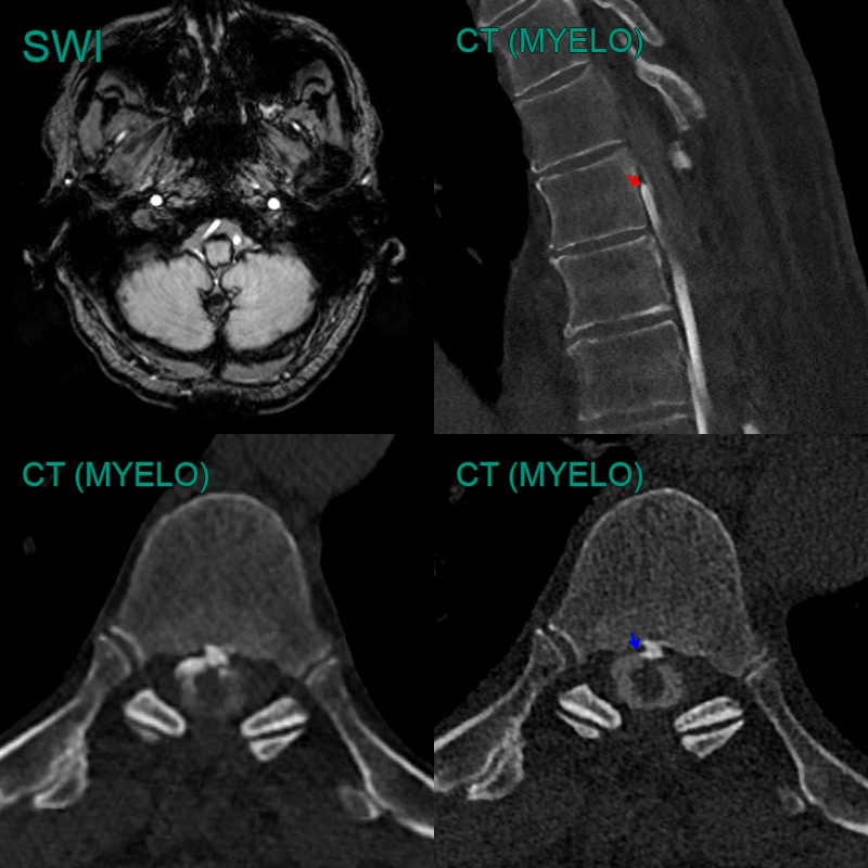 Spinal CSF leak - NEURORADIOLOGY