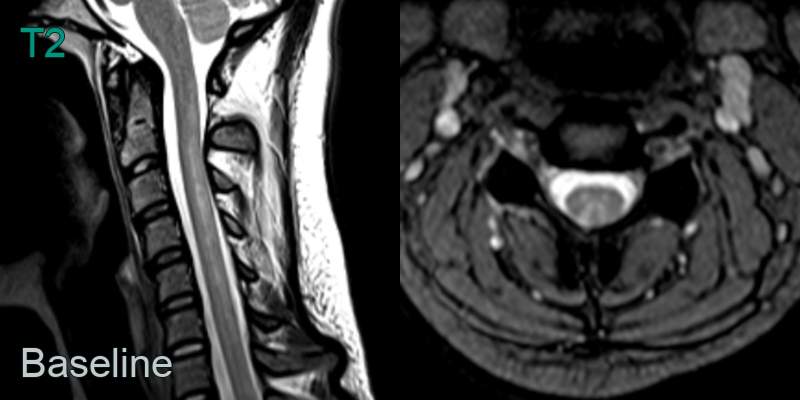 Subacute Combined Degeneration Of The Cord Sacd Neuroradiology