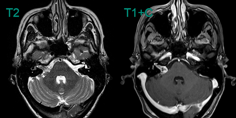 Vestibular schwannoma - NEURORADIOLOGY